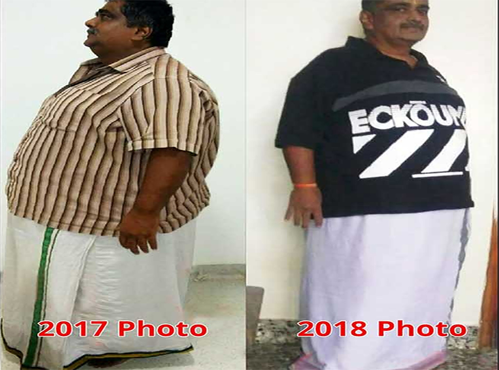 Vanugopal has gaind weight suddenly after retirement in his old age he was concerned then he went trough bariatric surgery in drtulipchamany care he got good results